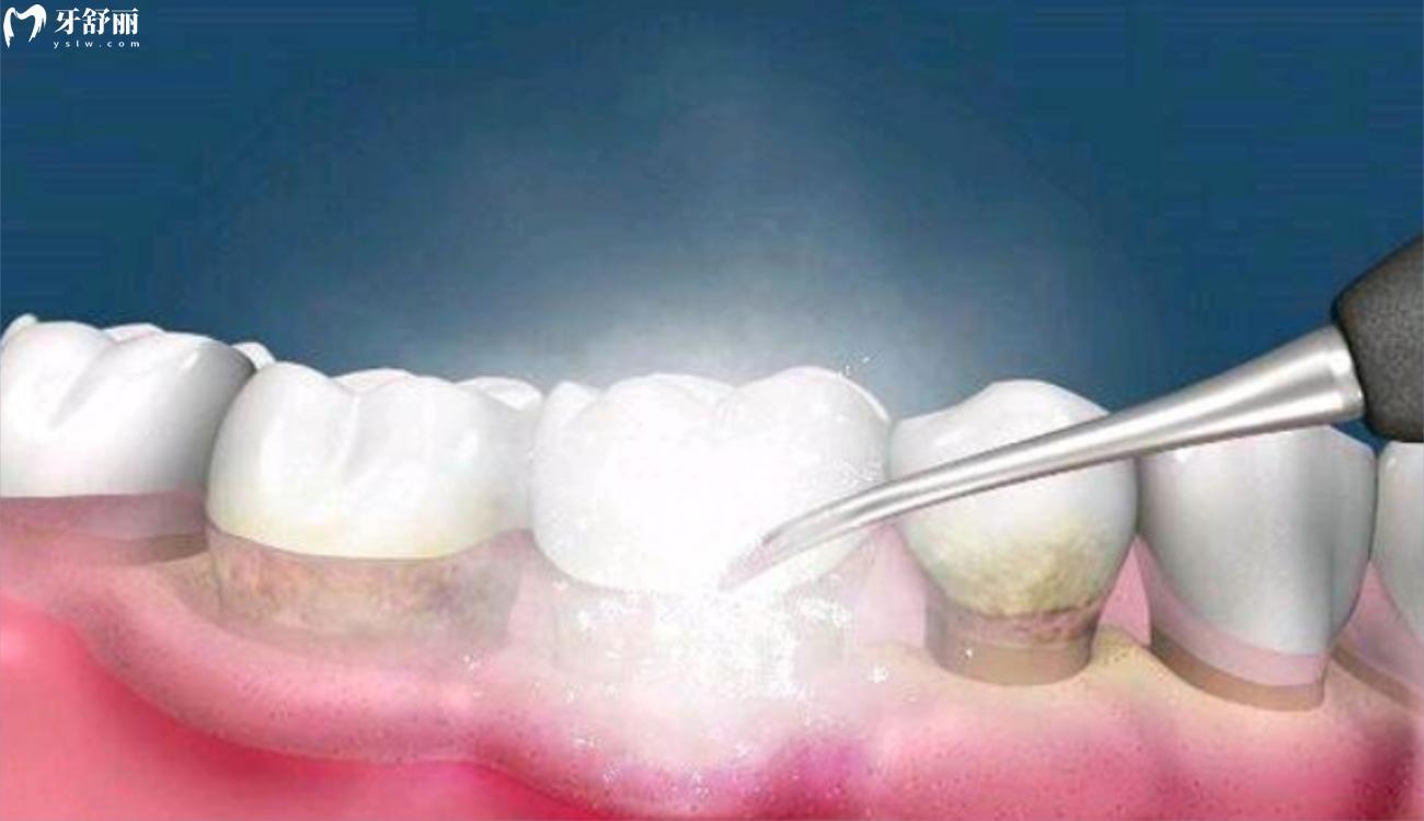 牙齿抛光和牙齿喷砂的区别.jpg