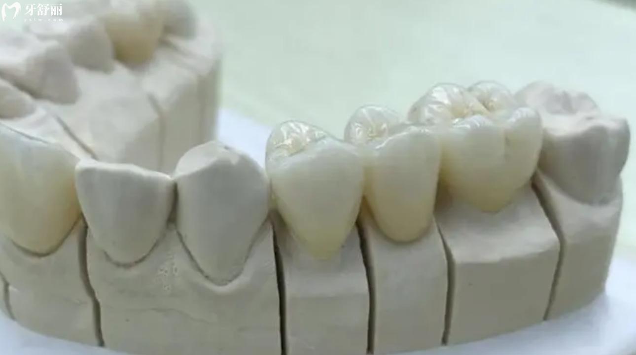 日本则武氧化锆全瓷牙多少钱一颗 揭秘全瓷牙槽点和优势