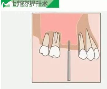 上颌窦提升术，为什么种植牙需要做上颌窦提升术