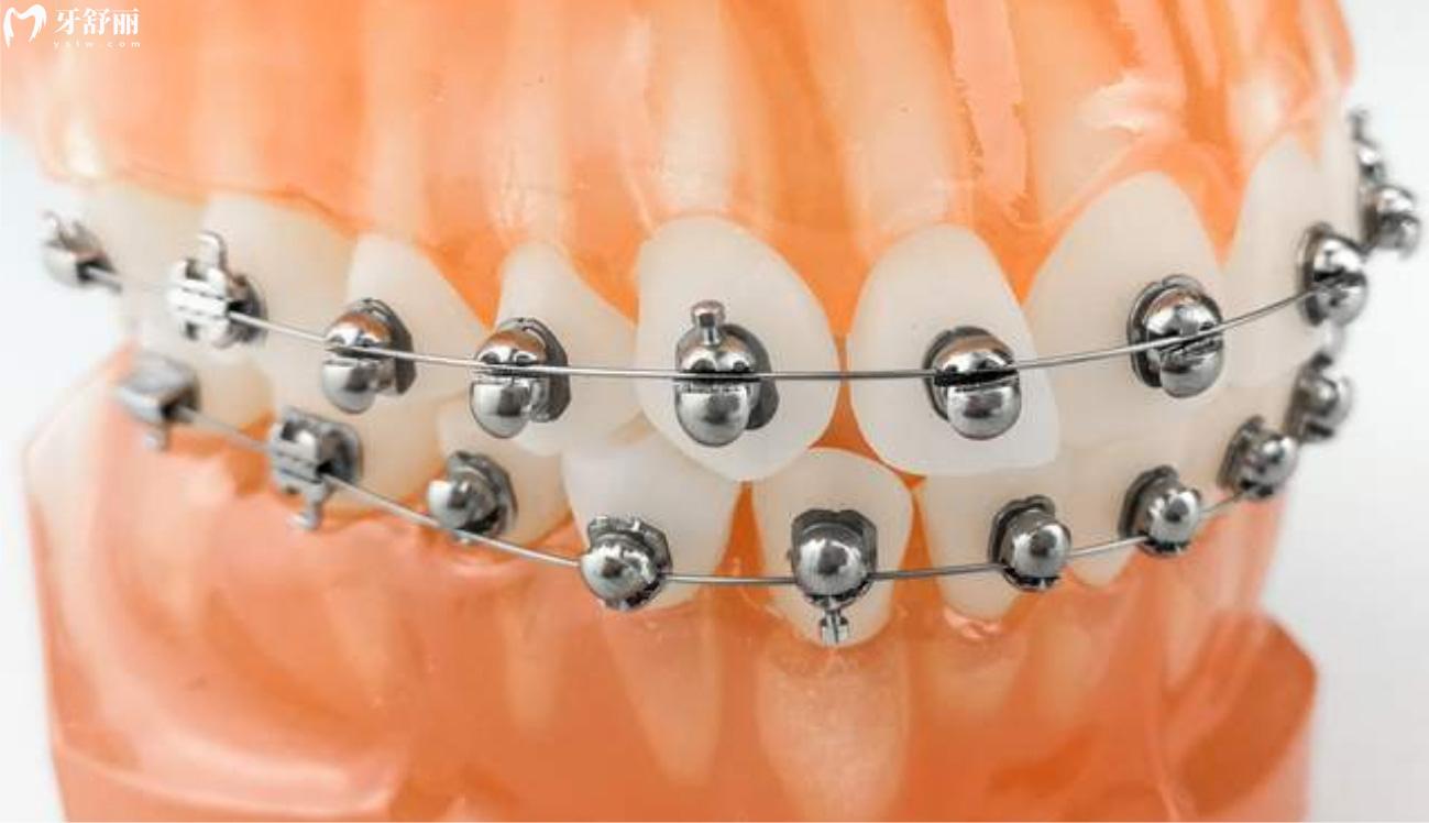牙齿矫正有哪几种方式.jpg