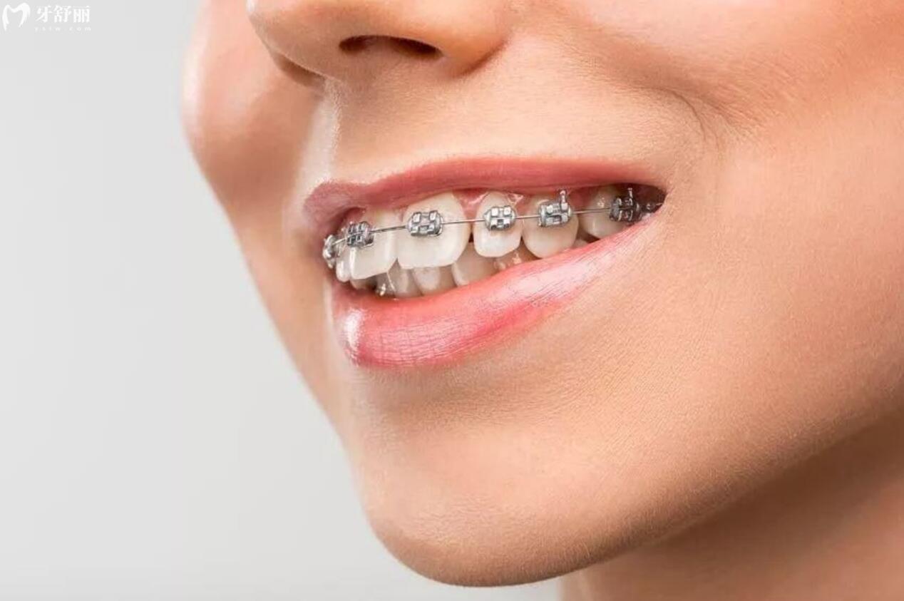 牙齿矫正多少钱价格表2023?想做牙齿矫正又怕被坑