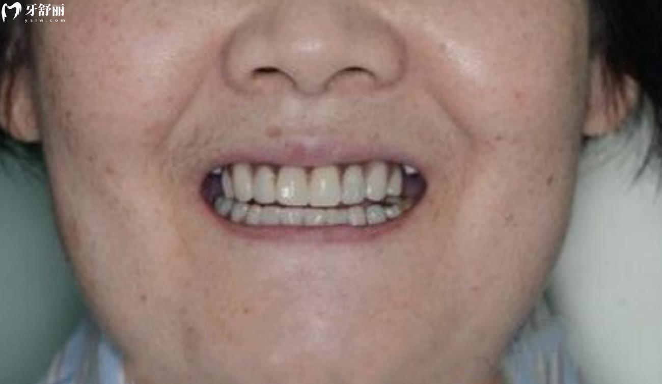 全口种植牙40-50岁病例分享.jpg