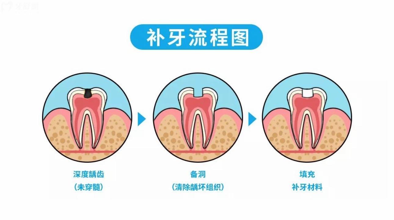 日本富士IX补牙材料和树脂补牙哪个好?维持年限是多久?