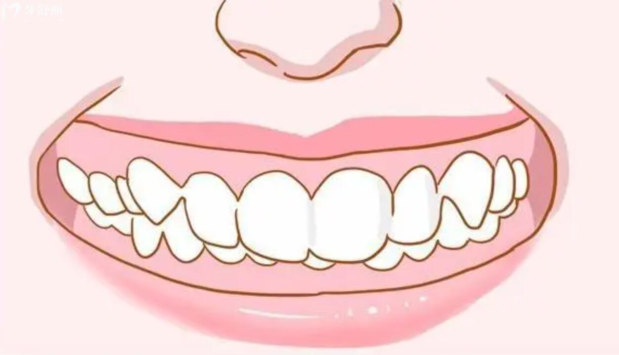 牙齿深覆合是什么原因导致的？不矫正的话会有什么后果吗