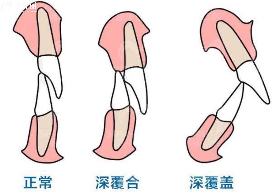 牙齿深覆合是什么原因导致的？不矫正的话会有什么后果吗