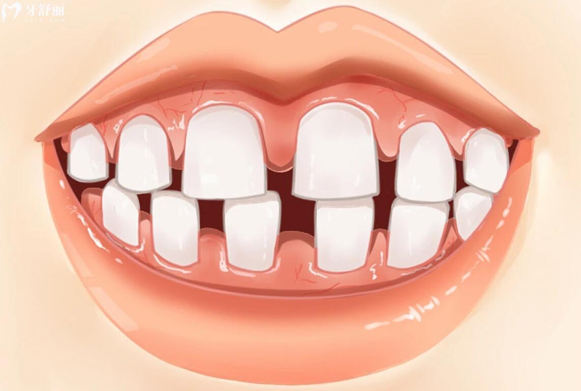 牙齿前凸和拔牙牙缝关不严有关系吗？哪个危害大