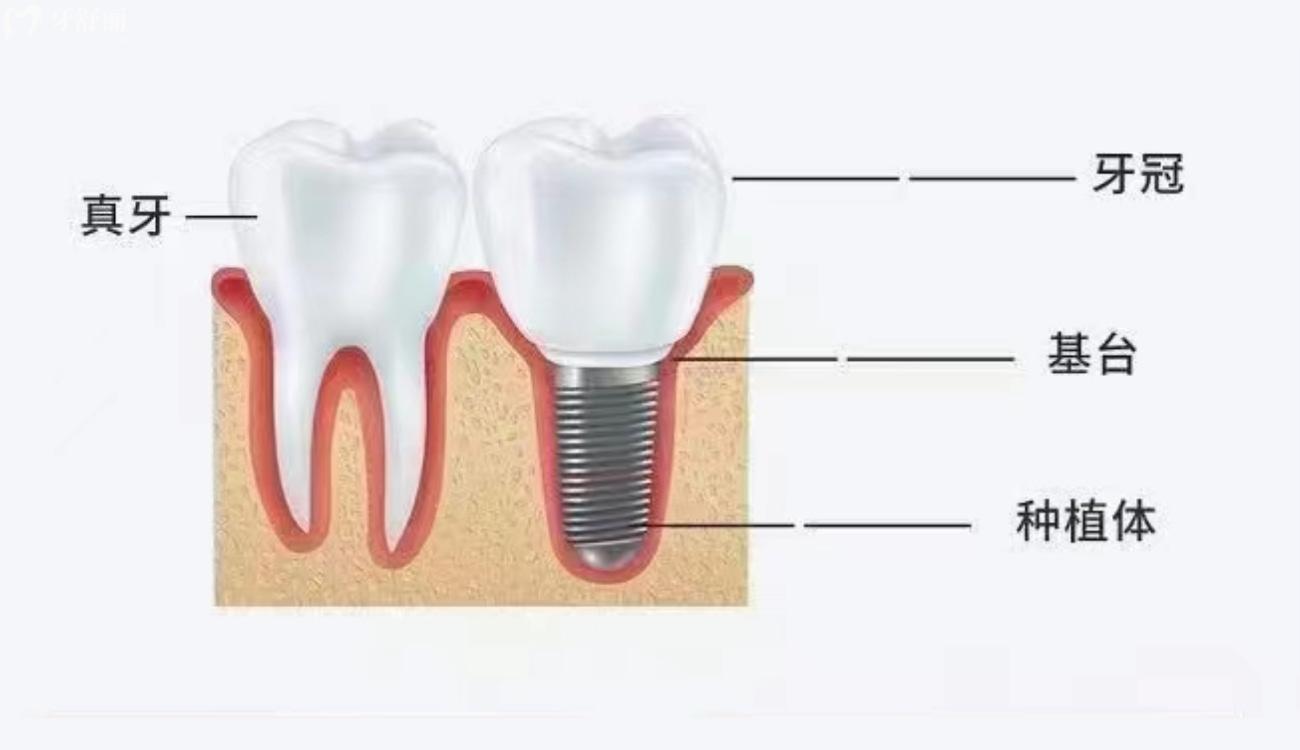 为什么选择种植牙来修复牙齿缺失.jpg