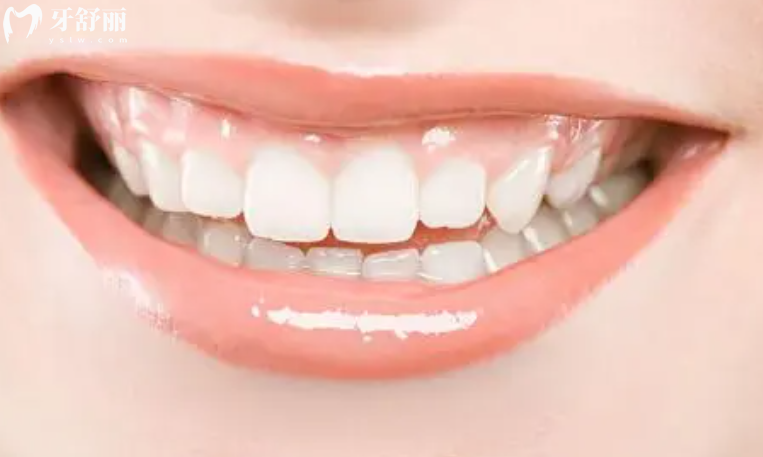 瓷贴面牙齿可以维持多久