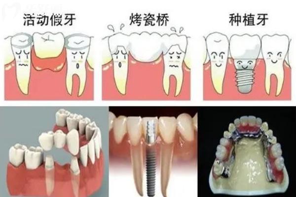 镶牙的三种方法