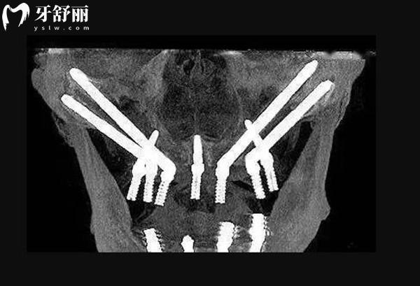 蚌埠种植牙多少钱一颗