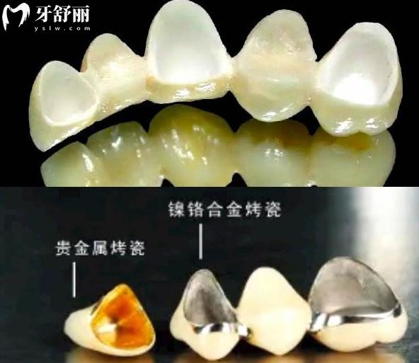 各种材质的牙冠