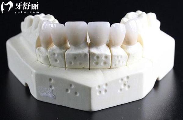 镶牙模型