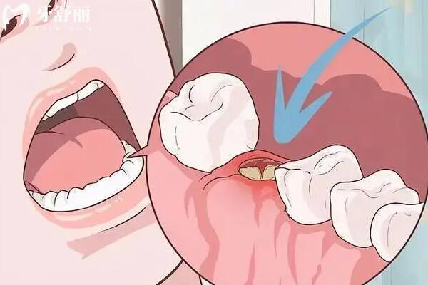 拔牙后疼痛怎么改善