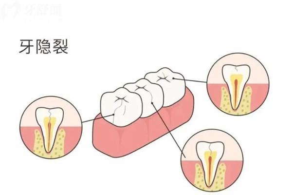 牙隐裂治疗方法