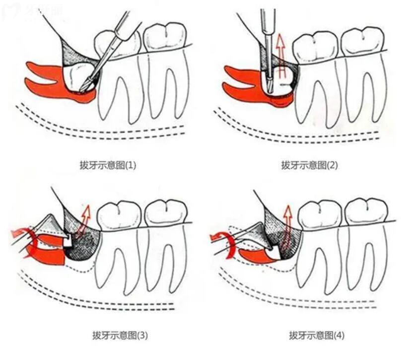 拔牙示意图