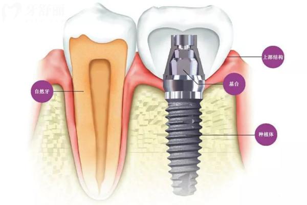 种植牙结构