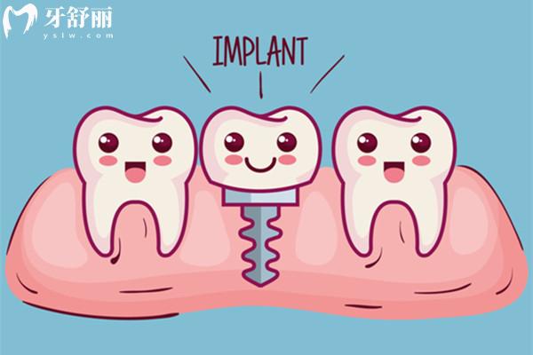 种植牙卡通图