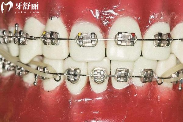 金属牙齿矫正