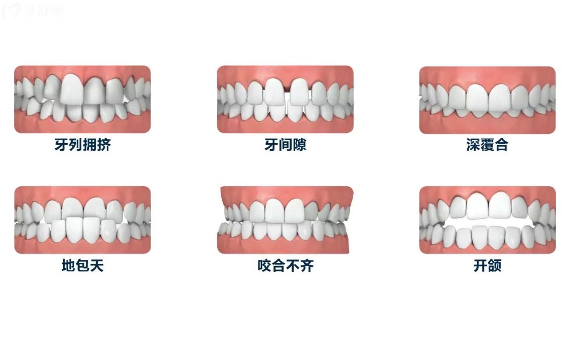 哪些情况需要做牙齿矫正