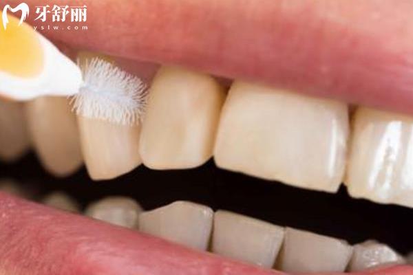 合理使用牙线或牙刷
