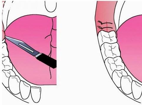 牙龈切除术示意图