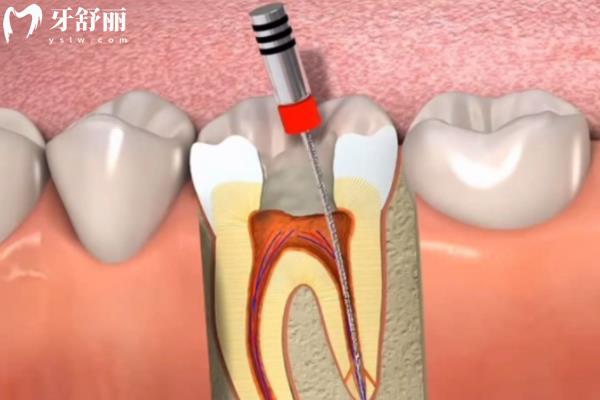 牙髓治疗