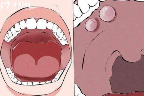 口腔黏膜恢复的好方法