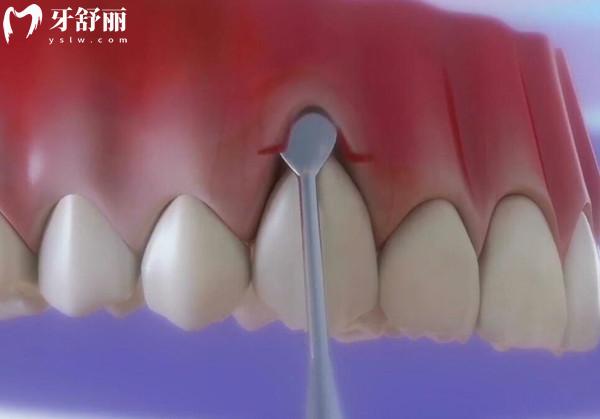 牙龈移植手术到底有用吗？