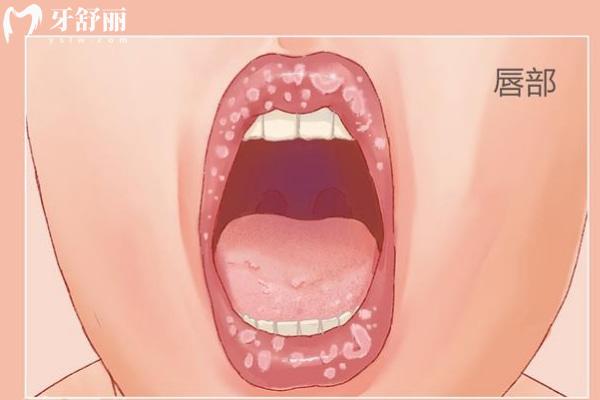 口腔扁平苔藓有什么症状
