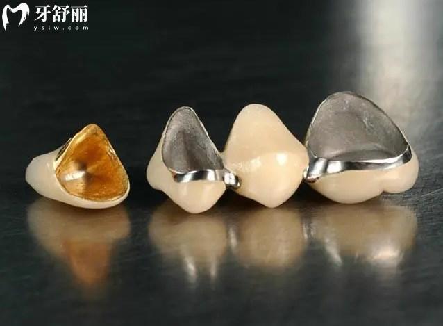 不同材质牙冠