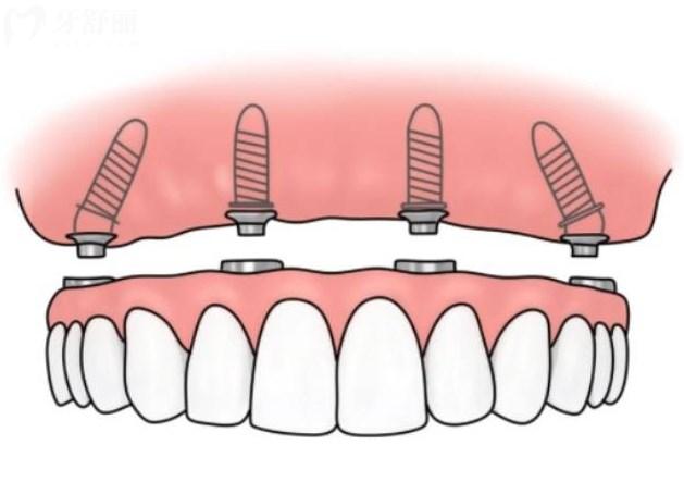 全口all-on-4种植牙