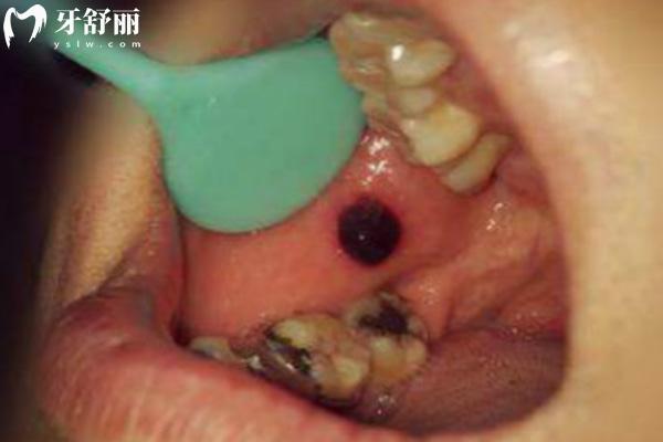 口腔癌早期10种征兆