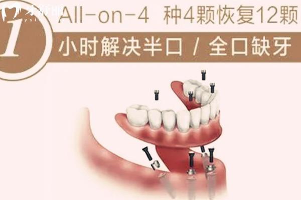 安顺牙科医院种植价格表