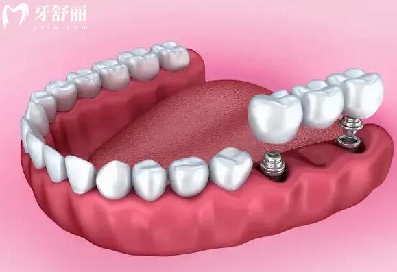 广州医科大学附属口腔医院收费标准:种植牙2600牙齿矫正7000拔智齿300