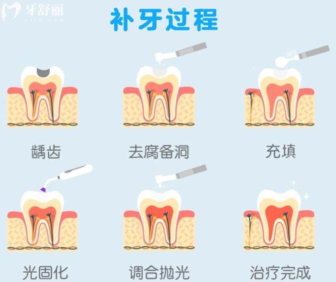 浅龋补牙过程