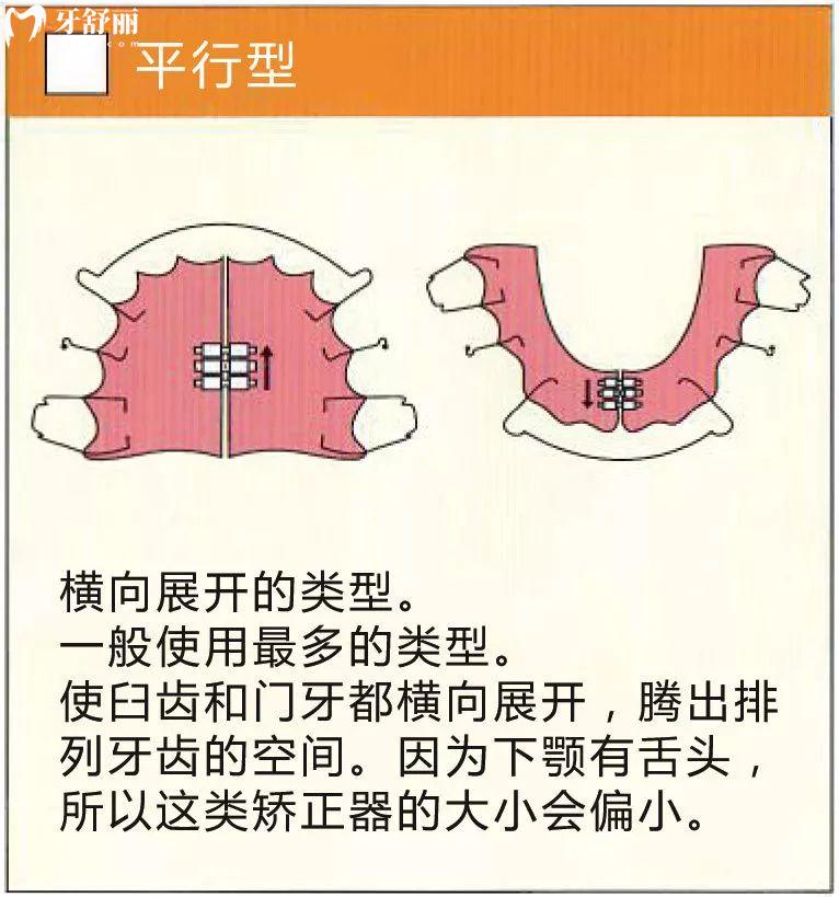 儿童平行型牙齿矫正器佩戴方法