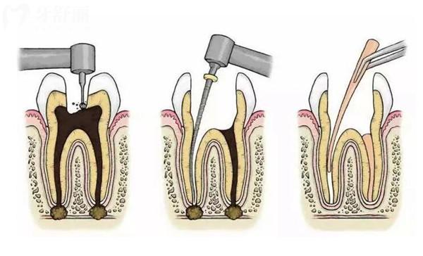 前牙根管治疗