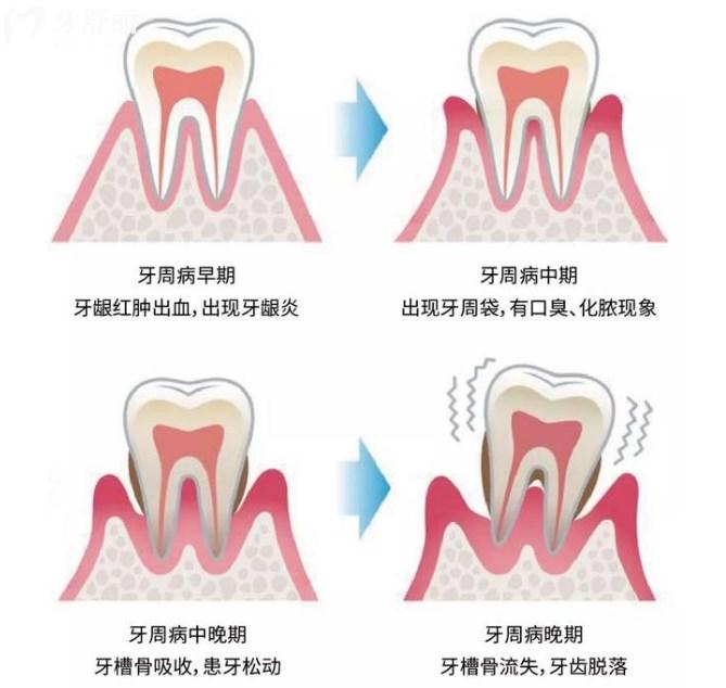 牙周病的四个发展过程