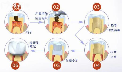 中山口腔医院收费价目表已出,拔智齿350种植牙2880矫正5500