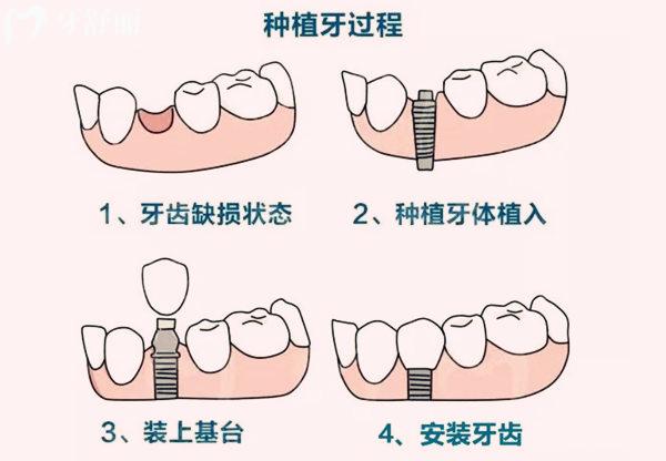 北京冠美口腔种植牙过程