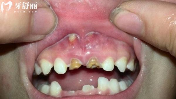 孩子牙齿钙化