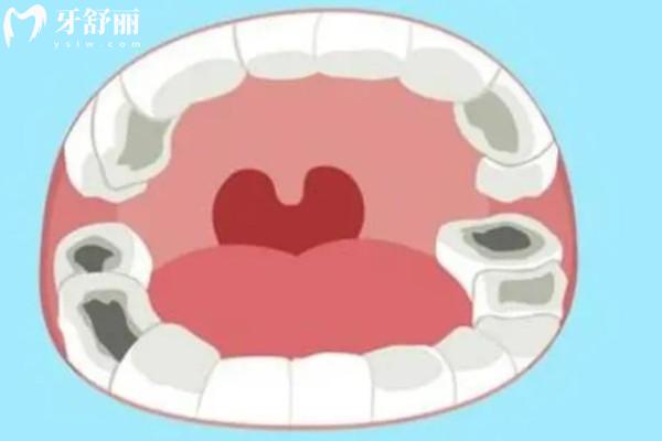 儿童龋齿对后期换牙有影响吗