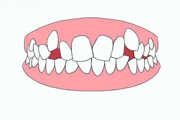 牙齿畸形需要矫正