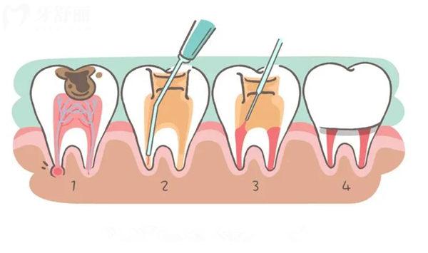 根管治疗过程图