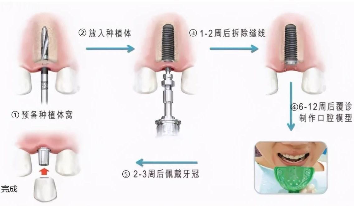 种植牙手术全过程