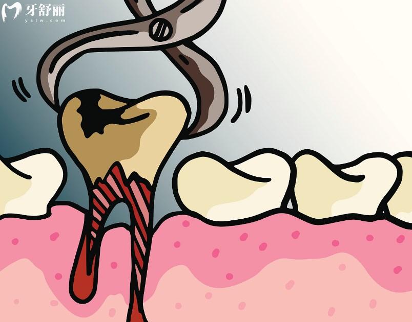 拔牙