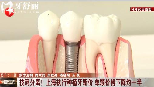 上海种植牙集采降价通知