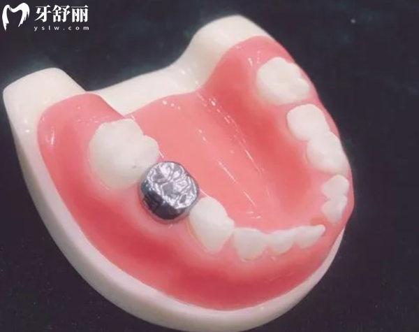 预成冠疗效图