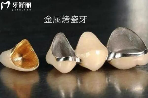 宁波江北牙科医院收费标准更新,种植牙