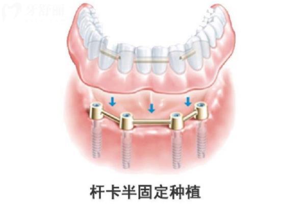 连云港牙科收费价目表